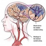 Accidentul vascular cerebral – cauze, factorii de risc si simptomele