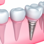 Totul despre implantul dentar