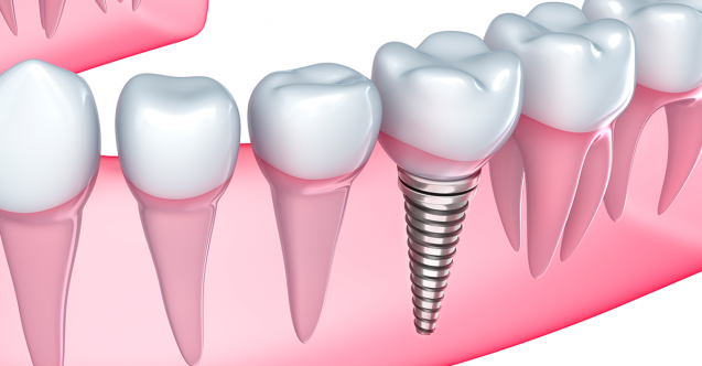 Implant-Dentar-637x332