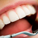 Albirea dinţilor: cum se face şi când e recomandată
