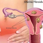 Fibrom uterin – factori de risc, simptome, tratament
