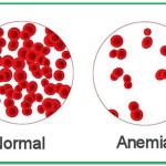 Anemia – cum o tratam?