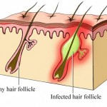 Foliculita – cauze, simptome, diagnostic si tratament