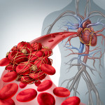 Cheaguri de sânge: cauze, simptome, metode de prevenire