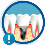 Augmentarea osoasa pentru implantul dentar